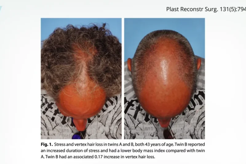 Biotin and Zinc Supplements: Fact or Fiction in the Fight Against Hair Loss?